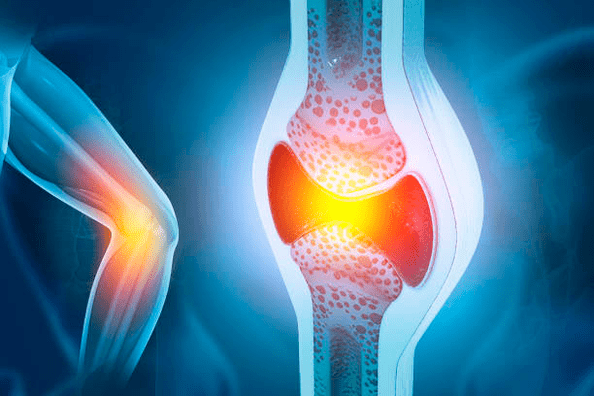 Eklem hastalıklarının önlenmesi