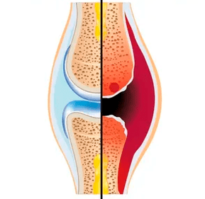 Kıkırdak dokusu ve sinovyal sıvının belirlenmesi ile sağlıklı ve yıpranmış bir eklemin yapısı